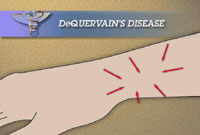 DeQuervain's Disease