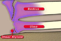 Radius & Ulna Fracture