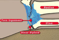 Torn Ligament