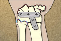 Joint Fusion Procedure